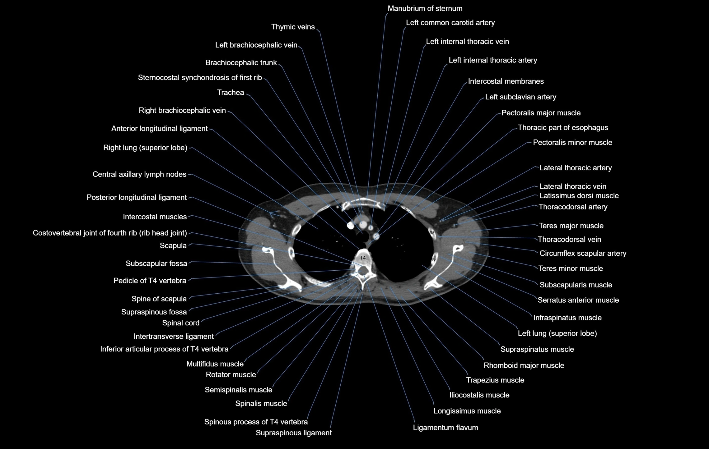 CT chest (thorax) labelled axial cross sectional anatomy radiology image-00028.webp